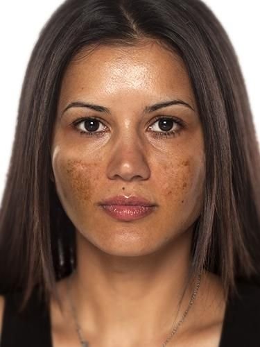 Hyperpigmentation Treatment