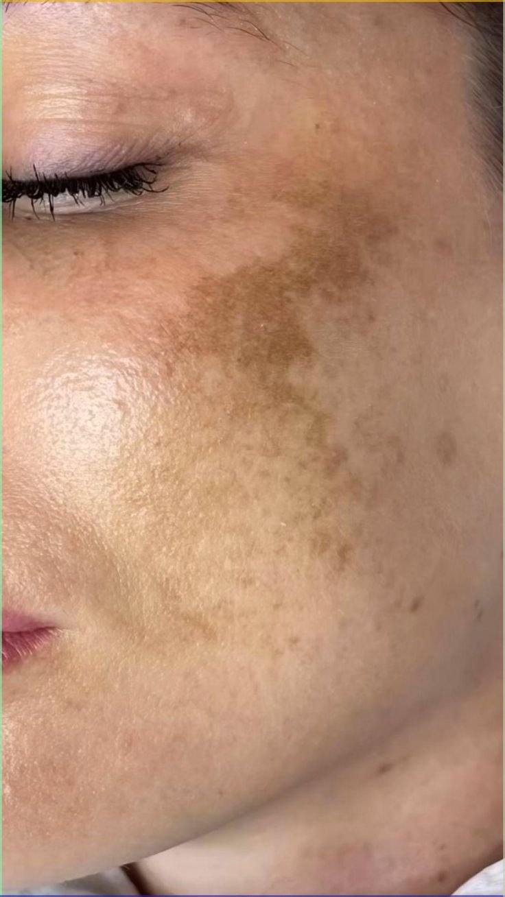 Hyperpigmentation Treatment