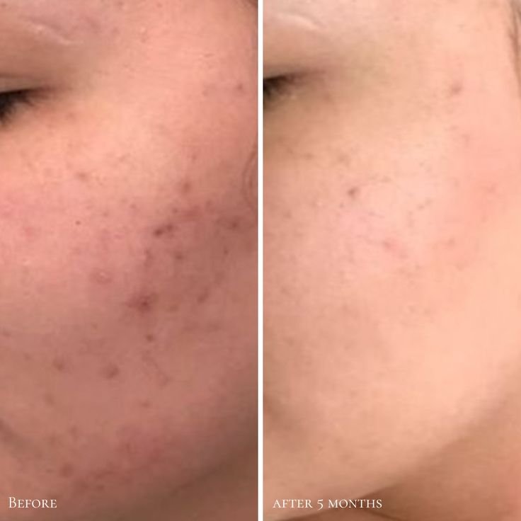 Cicaplast Baume B5 vs B5+ 06