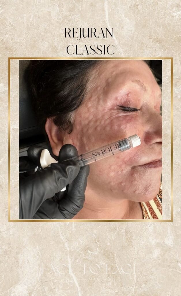 rejuran turnover ampoule review 08