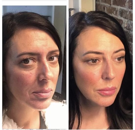 rejuran turnover ampoule review