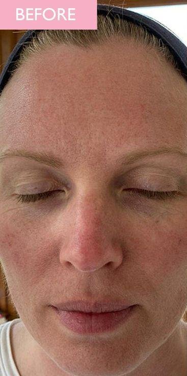 what is Beta-Glucan for skin